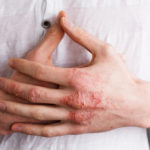 Eczema - hand