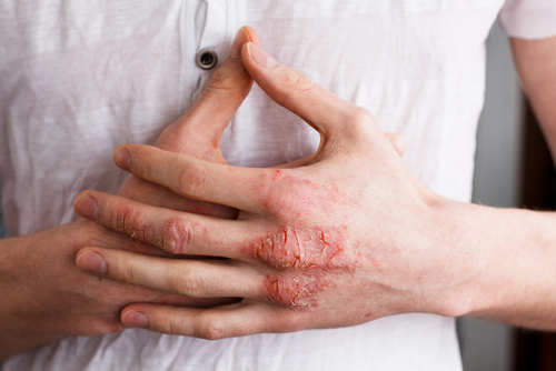 Eczema - hand