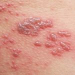 Shingles rash - Join a vaccine study for shingles or culebrilla