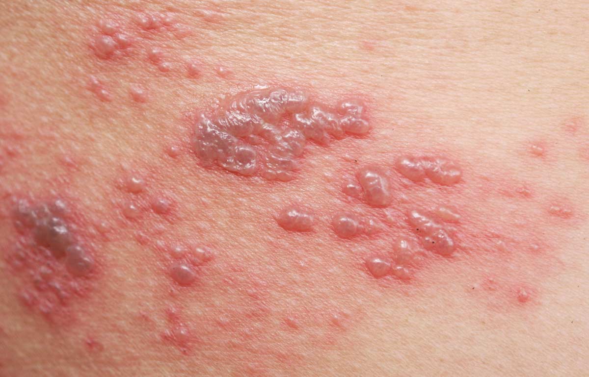 Shingles rash - Join a vaccine study for shingles or culebrilla