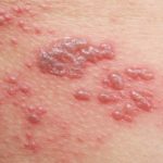 Culebrilla