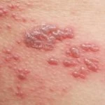 Shingles rash - Join a vaccine study for shingles or culebrilla