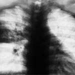 pneumonia