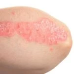 psoriasis