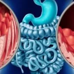 Celiac Disease