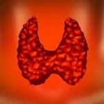 Hypothyroidism
